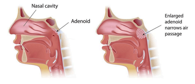 Understanding Adenoids A Comprehensive Guide Globule Clinics